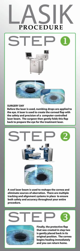 LASIK Procedure