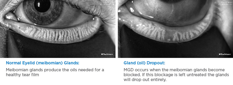 Normal vs MGD Glands