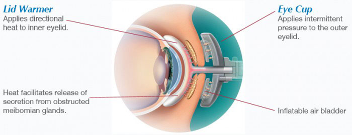 LipiFlow Dry Eye Treatment