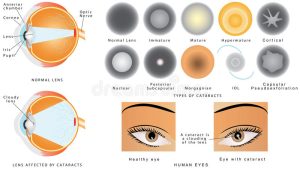 Cataract Awareness Month Lets talk about risk factors for developing cataracts and types of cataracts