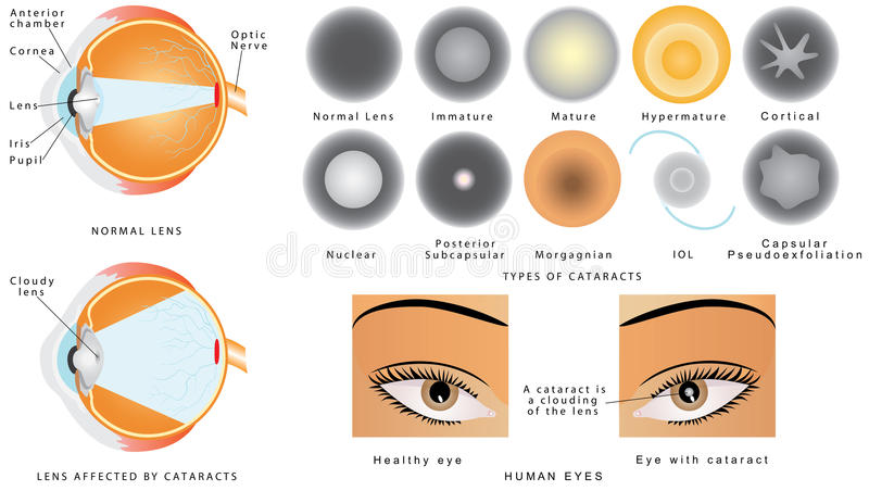 Types of cataracts