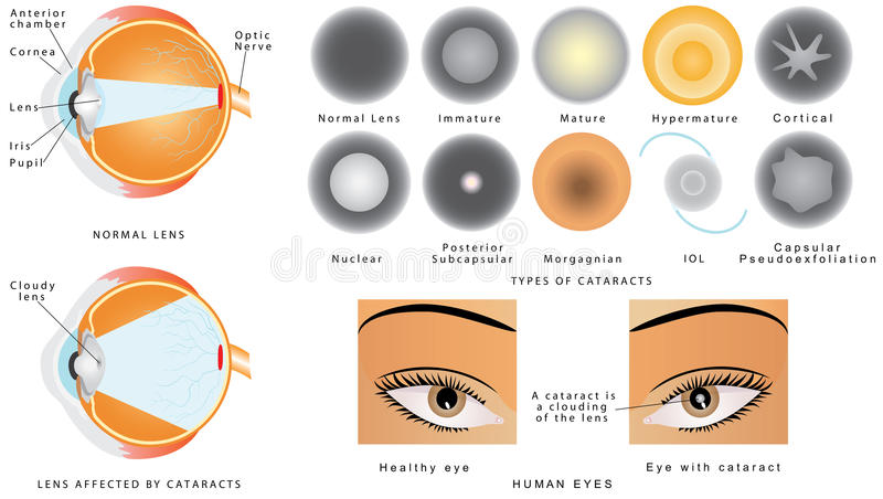 Cataract Awareness Month Lets talk about risk factors for developing cataracts and types of cataracts